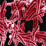 Rising Tuberculosis Cases in Texas: Health Officials Raise Concerns