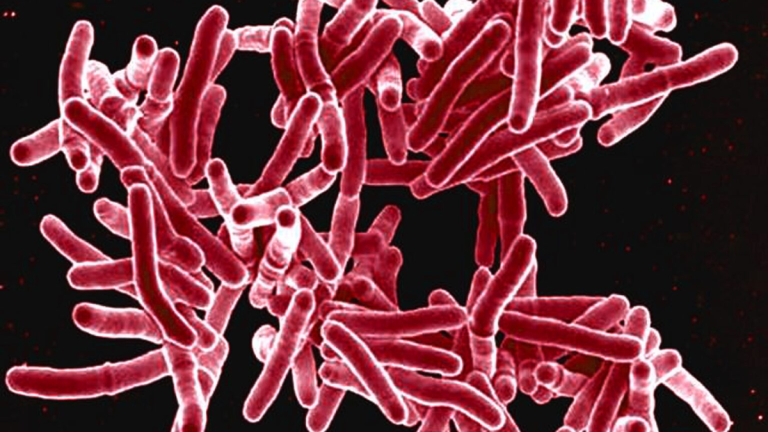 Rising Tuberculosis Cases in Texas: Health Officials Raise Concerns